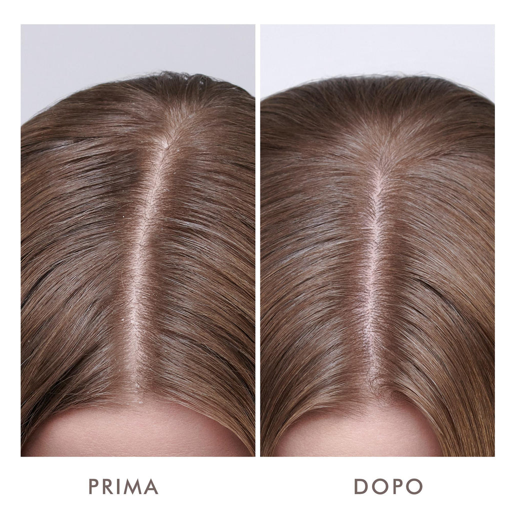 Dry Scalp Treatment